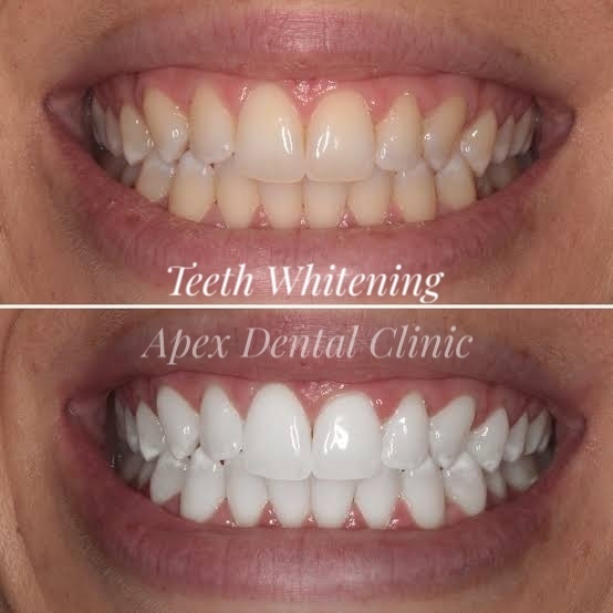 Before and After Teeth Whitening
