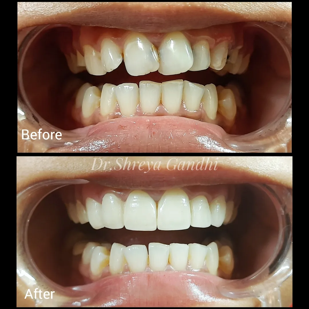 Before and After Smile Makeover